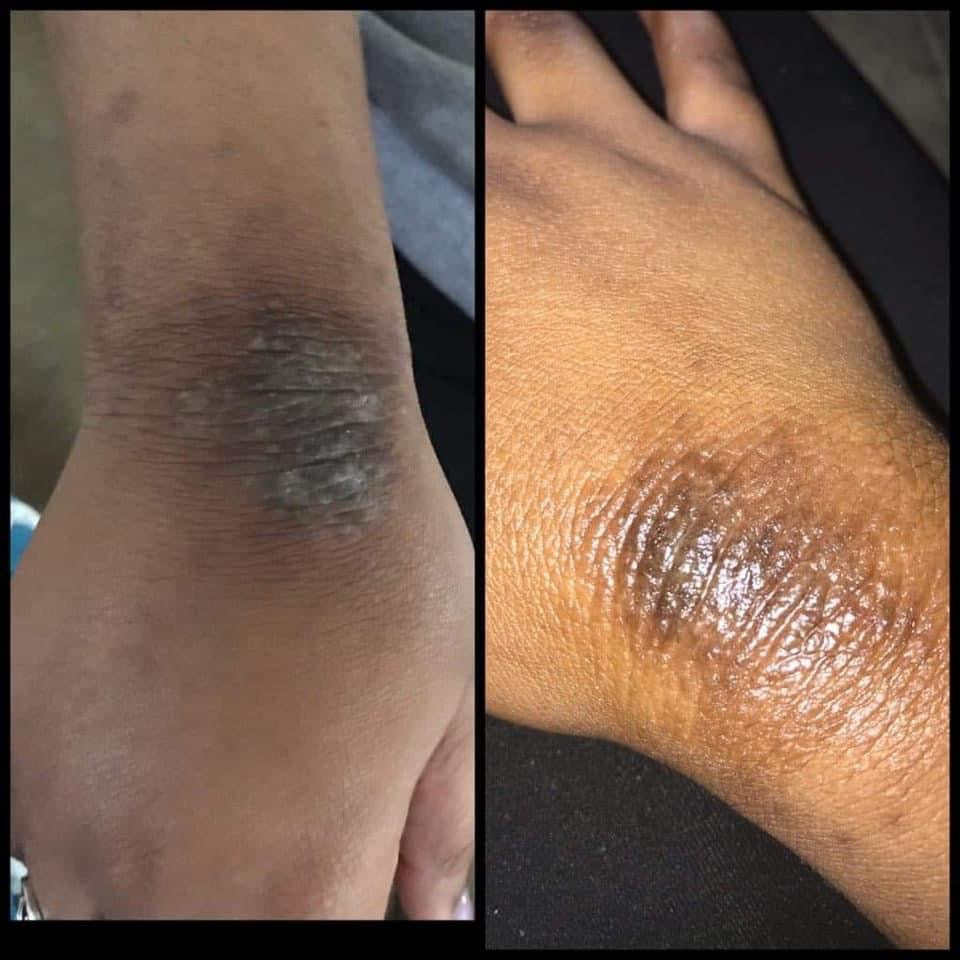 Kyrie’s Eczema Cream