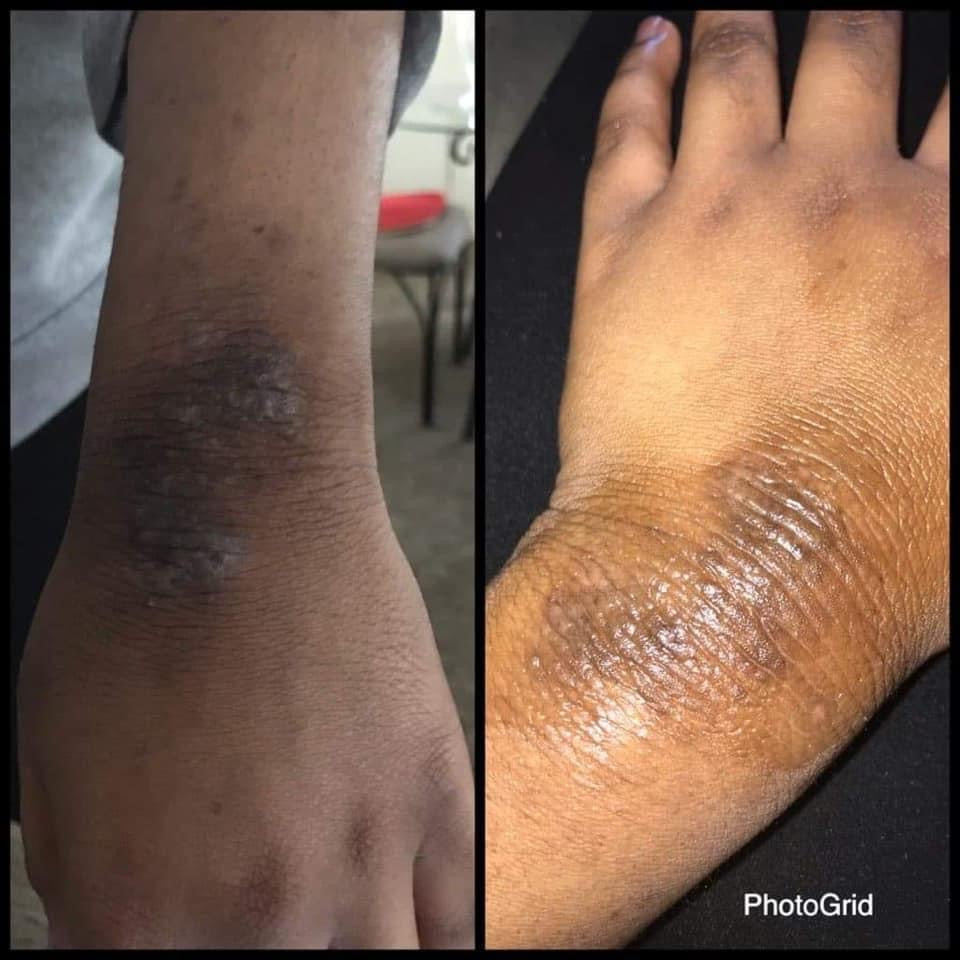 Kyrie’s Eczema Cream