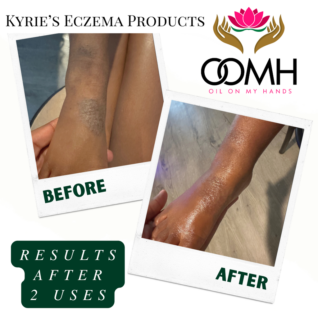 Kyrie’s Eczema Cream